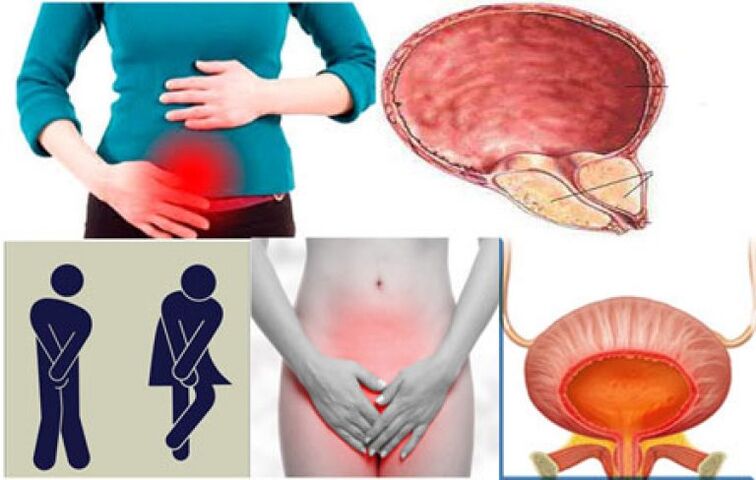 Signos de cistitis en mujeres ardor y dolor al orinar